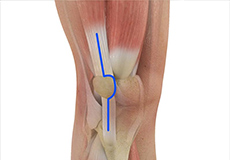 Muscle Sparing Knee Replacement